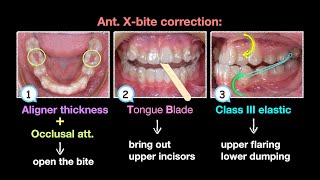 Anterior crossbite clinical tip aligner｜【Chris Chang Ortho】CC753 [upl. by Buehler]