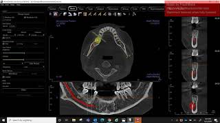 Invivo 6 Standard Resolution Implant Crown Down Plan Case [upl. by Eletnahc]