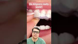 Do Aligners Really work youtubeshorts shortvideo shorts short teeth braces aligners [upl. by Ainotna]