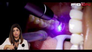 Excision of soft tissue Operculectomy by Pioon S1 Dental Diode Laser [upl. by Aiderfla]