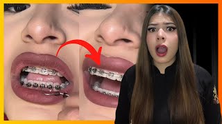 NÃO Estrague seu APARELHO DE DENTE Fazendo Isso  Dentista de Ouro reage [upl. by Ramgad696]