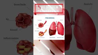 Lung sound in Pneumonia [upl. by Scott]