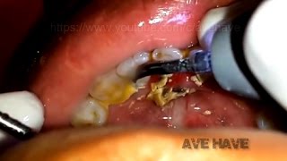 Plaque removed  Dental calculus  Long overdue plaque removal [upl. by Adnaw380]