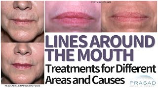 How to Treat Lines Folds and Wrinkles Around the Mouth and Lips [upl. by Tonia]