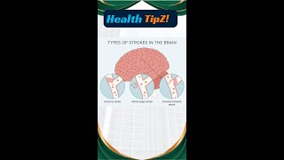 Types of stroke in brain sroke brainstroke [upl. by Aindrea]