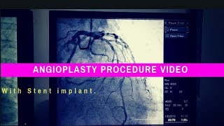 How heart stent inserted  Angioplasty Procedure video of heart  Stent Placement in Heart [upl. by Enelyw]