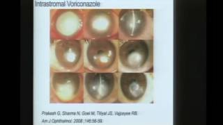 Innovations in Fungal Keratitis [upl. by Octave]