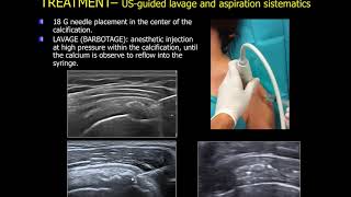 echoguided lavage of the calcific tendinitis of the shoulder [upl. by Nolte67]