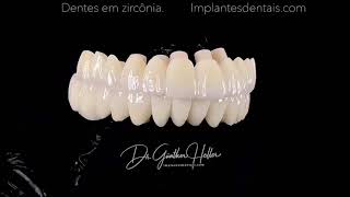 Dentes em zircônia para pontes fixas [upl. by Nedyah]