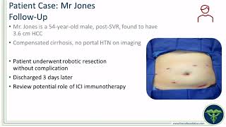 Expert Perspectives The Role of Immunotherapy in Advancing the Treatment of HCC and BTC [upl. by Lachish449]