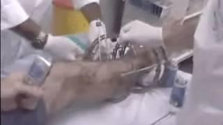 Part 2 External Fixation Removal  Ilizarov to full leg cast [upl. by Whitcher]