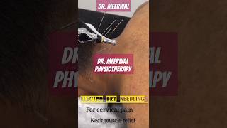 Electro dry needling cervical pain relieftreatments exercise cervicalpain cervicalradiculopathy [upl. by Toland]