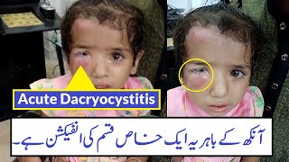 Case Study Of Acute Dacryocystitis  Urdu Hindi [upl. by Bazil710]