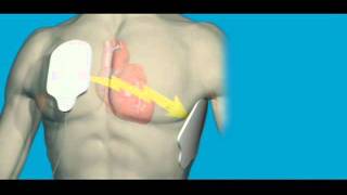 What is Cardiac Arrest [upl. by Adnomar]