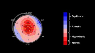 Interpreting the bulls eye plot in speckle tracking echocardiography [upl. by Hakim]