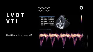 How to use the LVOT VTI to determine fluid responsiveness for the critically ill patient [upl. by Abebi]