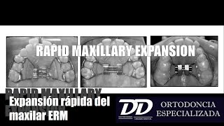 EXPANSION RAPIDA DEL MAXILAR [upl. by Ycul793]