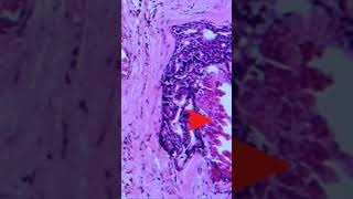 Ductal Carcinoma in Situ of Breast  Pathology shorts [upl. by Halsted759]