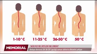 Skolyoz belirtileri nelerdir  Prof Dr Emre Acaroğlu Ortopedi ve Travmatoloji Uzmanı [upl. by Lissak]