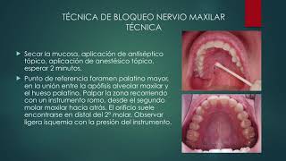 Anestesia dental nervio maxilar Universidad Austral Chile [upl. by Ulani]