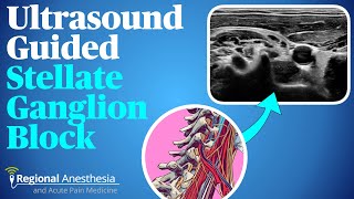 Ultrasound guided stellate ganglion block [upl. by Assyla]