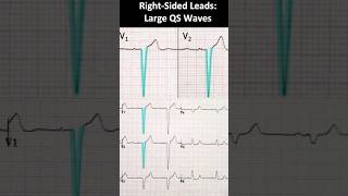 Left bundle branch block LBBB ECG Large QS waves in rightsided leads [upl. by Nittirb]