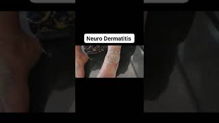 Lichen Simplex ChronicusNeuro Dermatitis dermatologist dr Bhutada Skin India [upl. by Curry744]