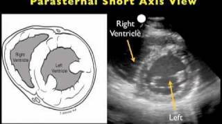 Cardiac Ultrasound  Parasternal Short Axis  Sonosite Inc [upl. by Enyrhtac588]