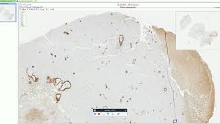 Cerebral Amyloid Angiopathy  Adventures in Neuropathology [upl. by Asseral987]