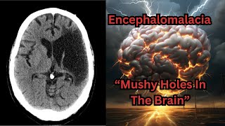 Encephalomalacia quotMushy Holes in the Brainquot from Traumatic Brain Injury [upl. by Leahcimsemaj471]