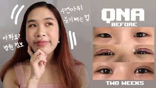 Double Eyelid Surgery Story  QnA 👁Price Hospital Info Did it Hurt 리얼 쌍수 후기 [upl. by Kirre]