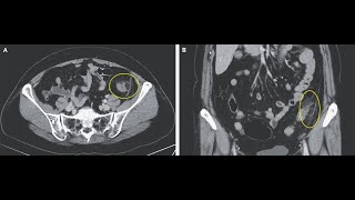 Akute Appendagitis epiploica [upl. by Ellehcsar]