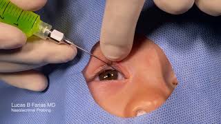 Probing of Nasolacrimal Duct with Fluorescein Irrigation [upl. by Ellennod]