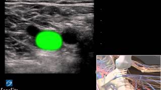 3D Comment Examen échographique dune Thrombose Veineuse Profonde  échographe SonoSite [upl. by Ahras]