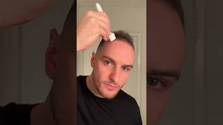 Derma stamp tutorial hair hairgrowth hairtransformation dermastamp microneedling dermaroller [upl. by Kimmi796]