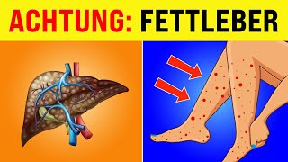 7 Anzeichen und Symptome von Fettleber [upl. by Idnar]