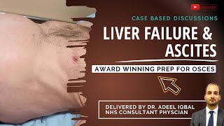 Liver Failure  Abdominal  BEST OSCE Preparation for Medical Student Exams [upl. by Esirtal419]