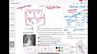 Truncus arteriosus congenitalheartdefect cardiology 52  First Aid USMLE Step 1 in UrduHindi [upl. by Coleville523]