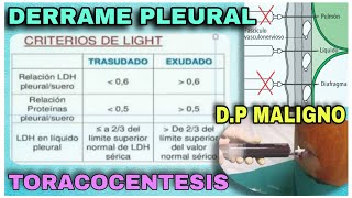 Derrame pleural TORACOCENTESIS DP maligno  Práctica  Casos clínicos  Dra Jauregui [upl. by Allsun]