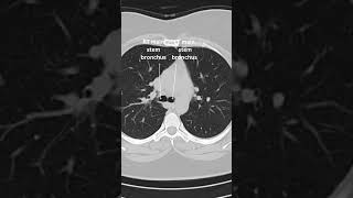 Discover the intricate details of thorax CT anatomy in this comprehensive YouTube video [upl. by Dambro38]