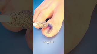 How Toenail Removal Works 😨 Hindi Explained youtubeshorts [upl. by Jeno]