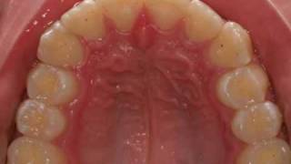 invisalign severe overjet [upl. by Ahsitel]