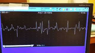 hypoglossal myokymia 3 [upl. by Bubalo]