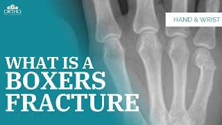 What Is A Boxers Fracture injury [upl. by Halika686]