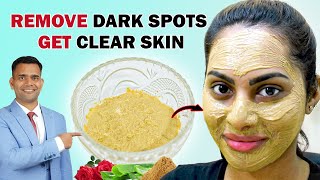 Remove Dark Spots and Get Clear Skin Naturally At Home  Dr Vivek Joshi [upl. by Atirb]