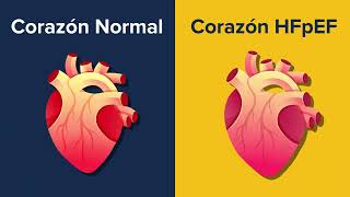 Estudio clínico para aprender más sobre HFpEF falla cardiaca e identificar futuros tratamientos [upl. by Aihn437]