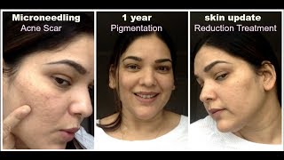 Microneedling 1 Year skin Update Acne scar reduction pigmentation old age wrinkles treatment [upl. by Atinat]