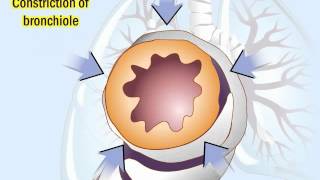 COPD Pathophysiology and Diagnosis [upl. by Nidak]