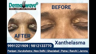 Xanthelasma Treatment  Dermawave Skin Clinic Panipat  Patna  Jammu  Kurukshetra  New Delhi [upl. by Ivanna]