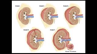 Blunt Abdominal Trauma Part 4 Renal Injury [upl. by Mcevoy]